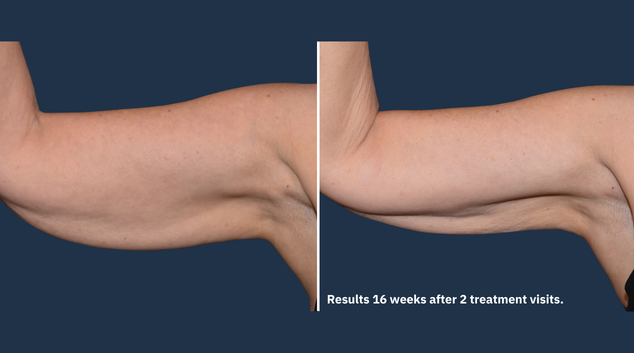 CoolSculpting Elite arm results